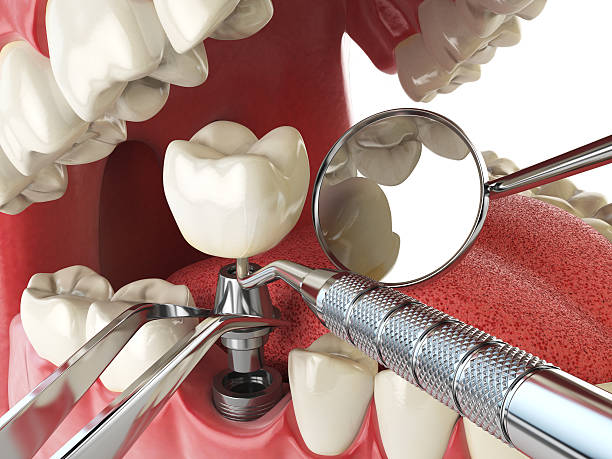 Best Emergency Root Canal Treatment in Prairieville, LA